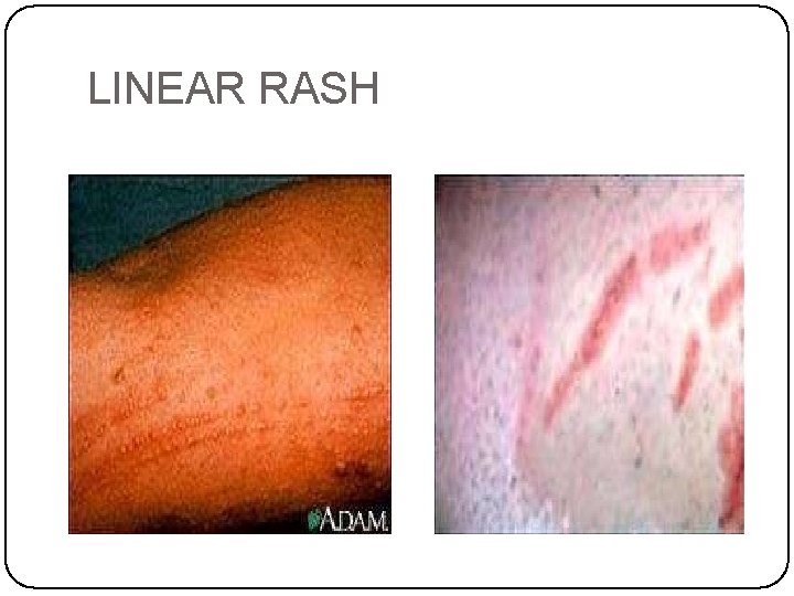 LINEAR RASH 