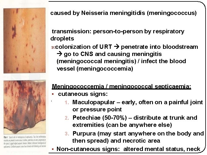  • caused by Neisseria meningitidis (meningococcus) • transmission: person-to-person by respiratory droplets colonization