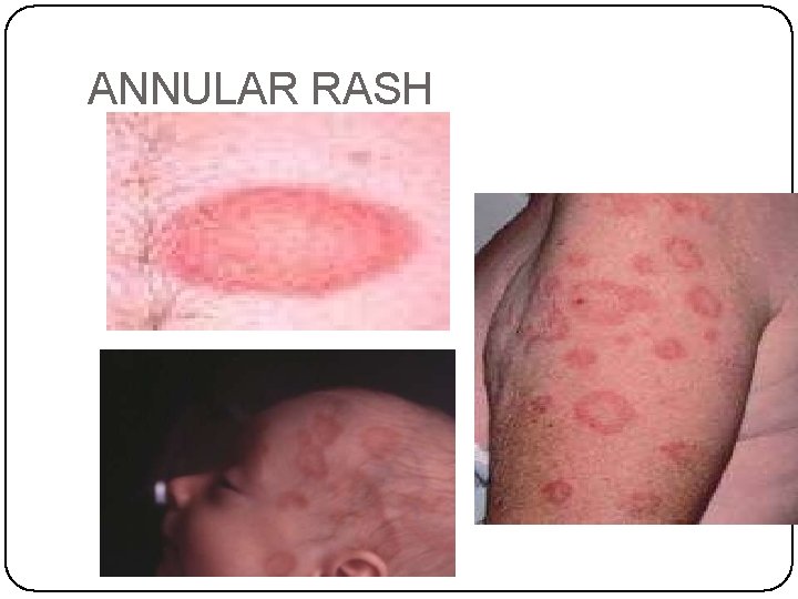 ANNULAR RASH 