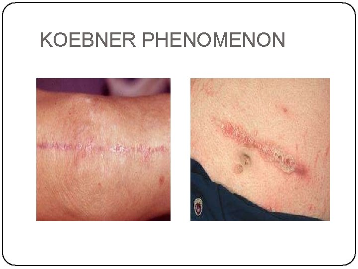 KOEBNER PHENOMENON 