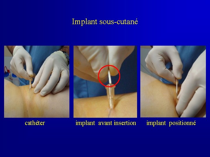 Implant sous-cutané cathéter implant avant insertion implant positionné 