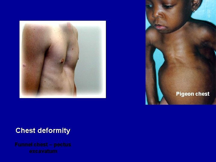 Pigeon chest Chest deformity Funnel chest – pectus excavatum 