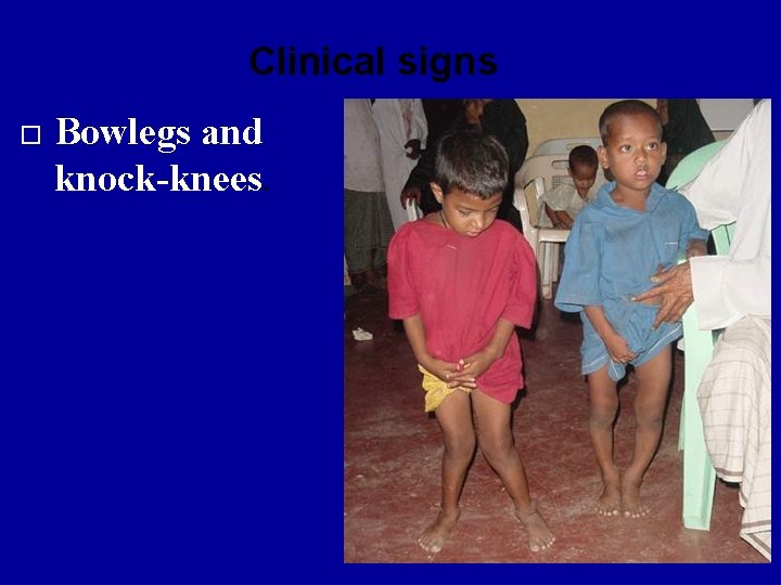 Clinical signs Bowlegs and knock-knees. 
