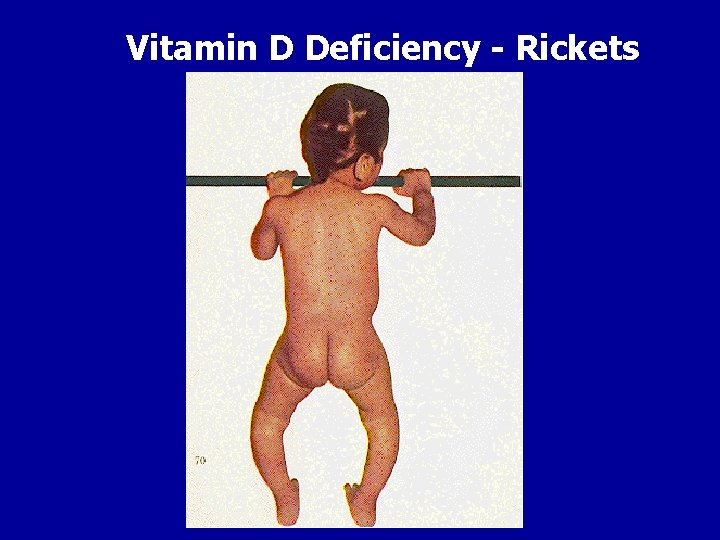 Vitamin D Deficiency - Rickets 