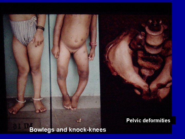 Pelvic deformities Bowlegs and knock-knees 