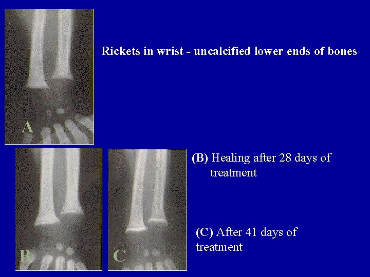 Rickets in wrist - uncalcified lower ends of bones A (B) Healing after 28
