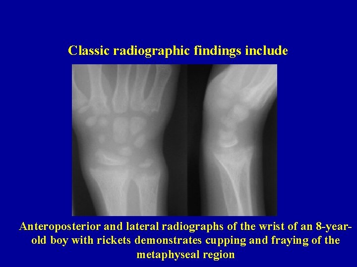 Classic radiographic findings include Anteroposterior and lateral radiographs of the wrist of an 8