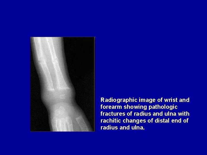 Radiographic image of wrist and forearm showing pathologic fractures of radius and ulna with