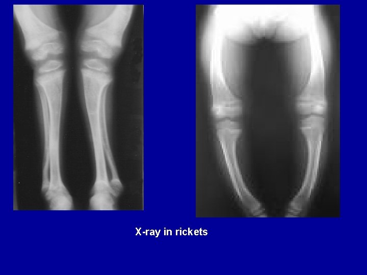 X-ray in rickets 