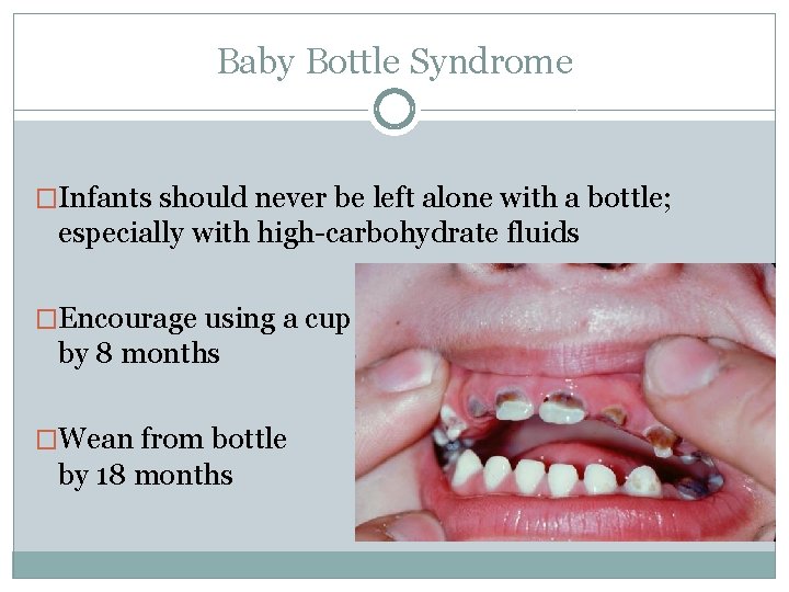 Baby Bottle Syndrome �Infants should never be left alone with a bottle; especially with