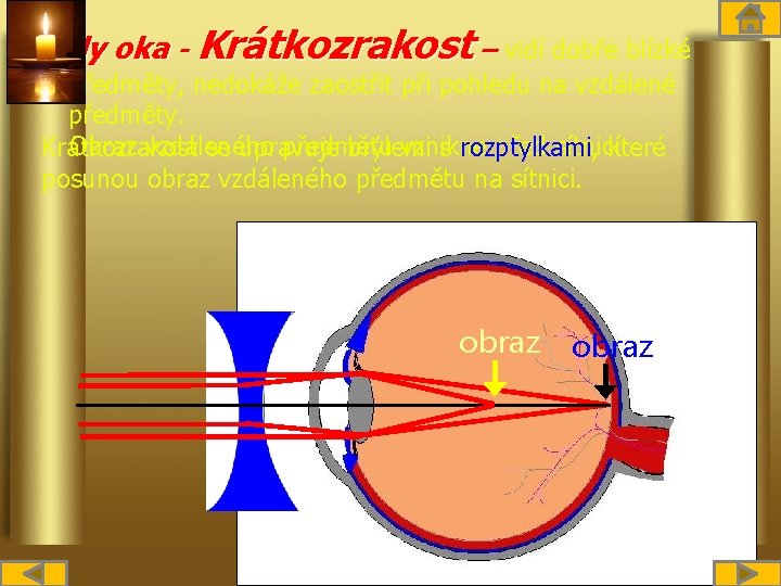 Vady oka - Krátkozrakost – vidí dobře blízké předměty, nedokáže zaostřit při pohledu na