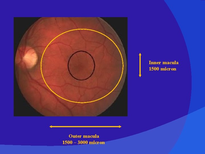 Inner macula 1500 micron Outer macula 1500 – 3000 micron 