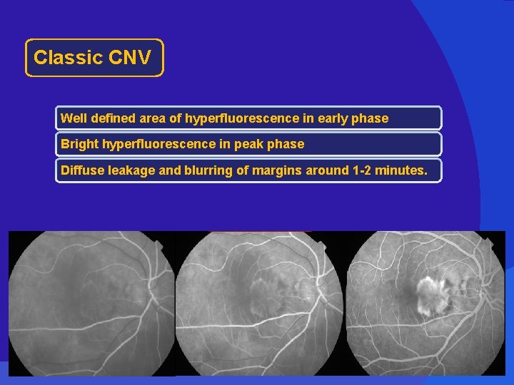 Classic CNV Well defined area of hyperfluorescence in early phase Bright hyperfluorescence in peak