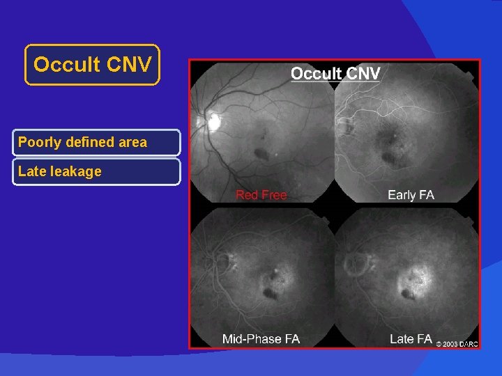 Occult CNV Poorly defined area Late leakage 