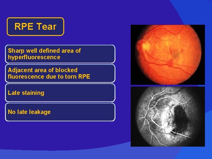 RPE Tear Sharp well defined area of hyperfluorescence Adjacent area of blocked fluorescence due