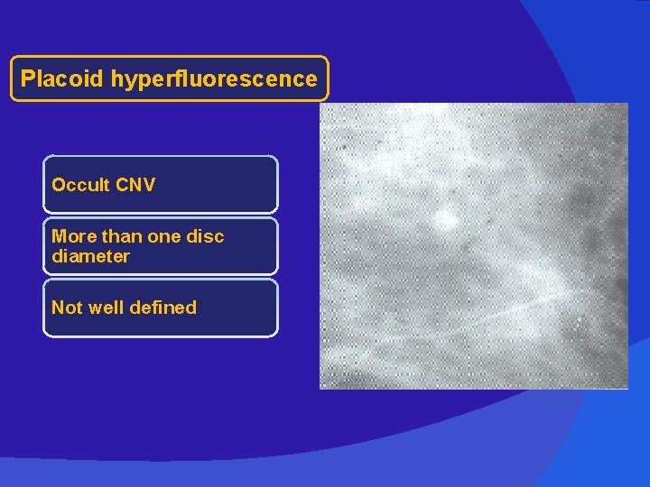 Placoid hyperfluorescence Occult CNV More than one disc diameter Not well defined 