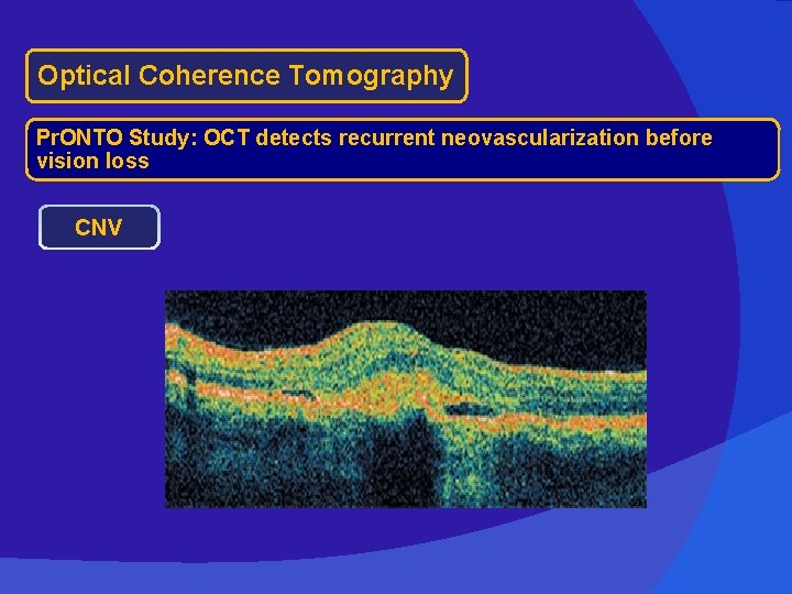 Optical Coherence Tomography Pr. ONTO Study: OCT detects recurrent neovascularization before vision loss CNV