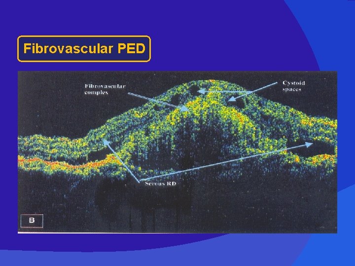 Fibrovascular PED 