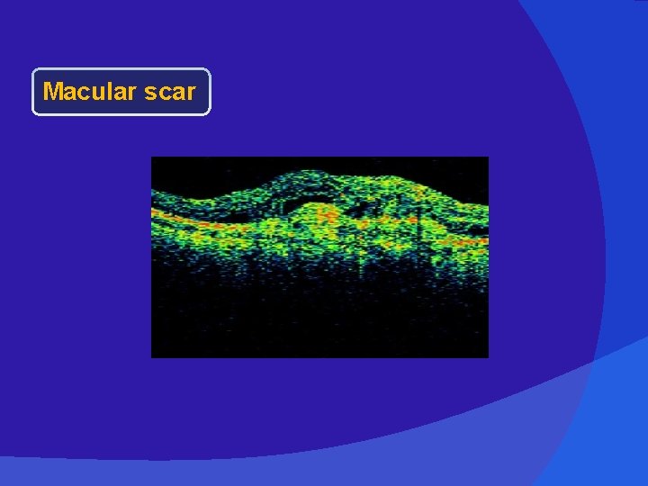 Macular scar 