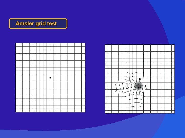 Amsler grid test 