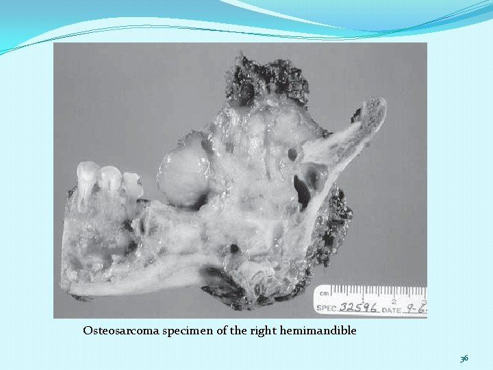 Osteosarcoma specimen of the right hemimandible 36 