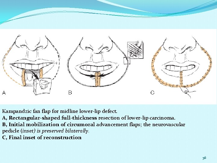 Karapandzic fan flap for midline lower-lip defect. A, Rectangular-shaped full-thickness resection of lower-lip carcinoma.