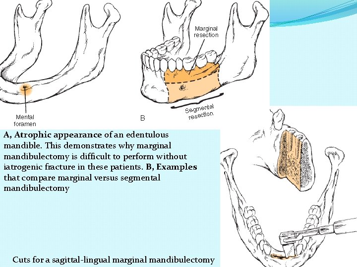 A, Atrophic appearance of an edentulous mandible. This demonstrates why marginal mandibulectomy is difficult