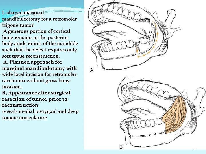 L-shaped marginal mandibulectomy for a retromolar trigone tumor. A generous portion of cortical bone