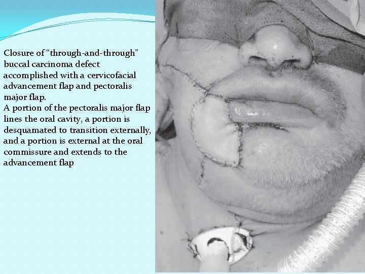 Closure of “through-and-through” buccal carcinoma defect accomplished with a cervicofacial advancement flap and pectoralis