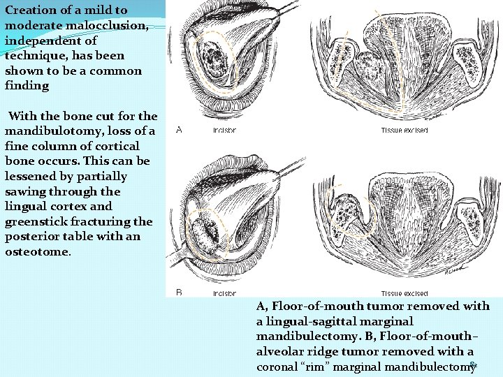 Creation of a mild to moderate malocclusion, independent of technique, has been shown to