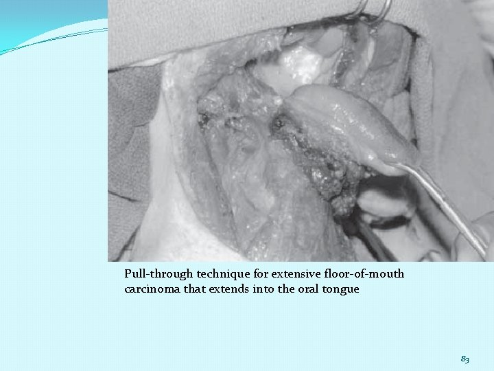 Pull-through technique for extensive floor-of-mouth carcinoma that extends into the oral tongue 83 