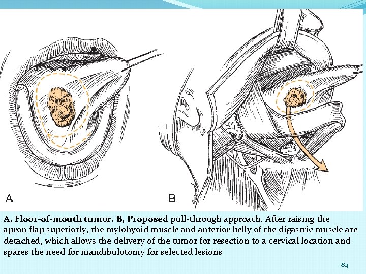 A, Floor-of-mouth tumor. B, Proposed pull-through approach. After raising the apron flap superiorly, the