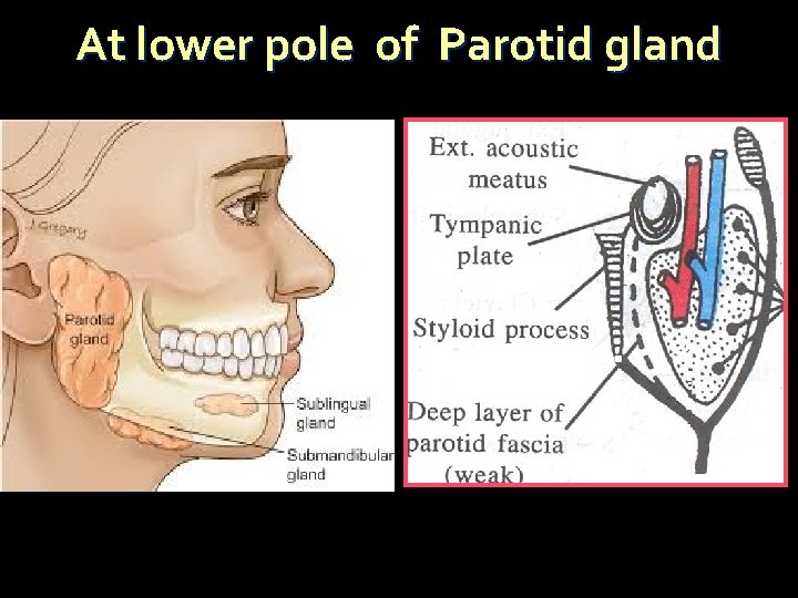 At lower pole of Parotid gland 