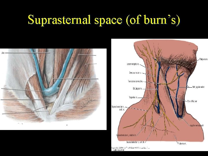 Suprasternal space (of burn’s) 