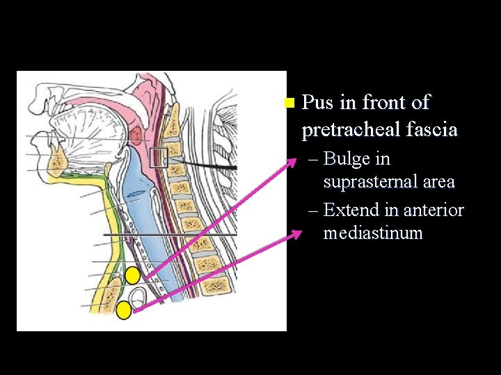 n Pus in front of pretracheal fascia – Bulge in suprasternal area – Extend