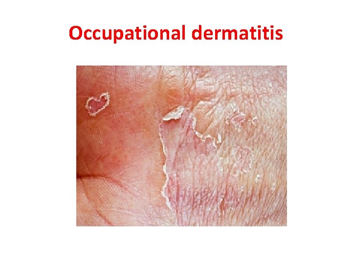 Occupational dermatitis 