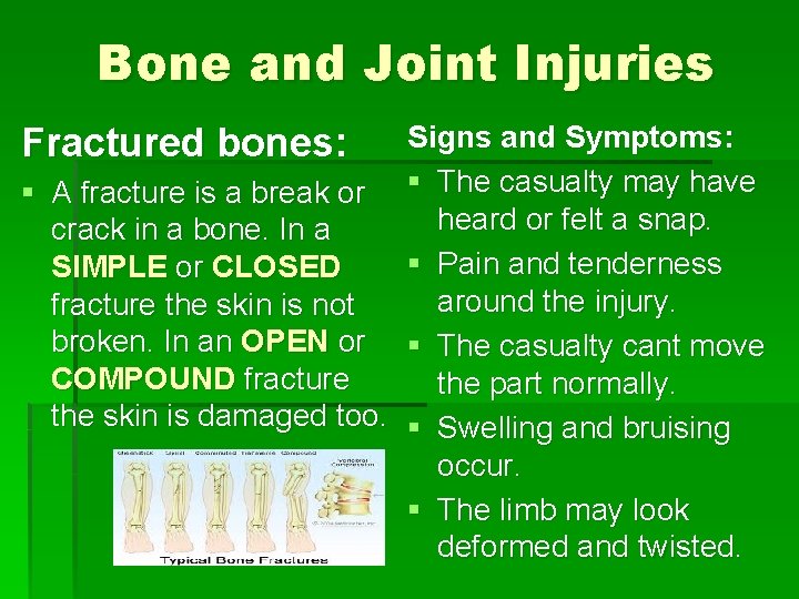 Bone and Joint Injuries Signs and Symptoms: § A fracture is a break or