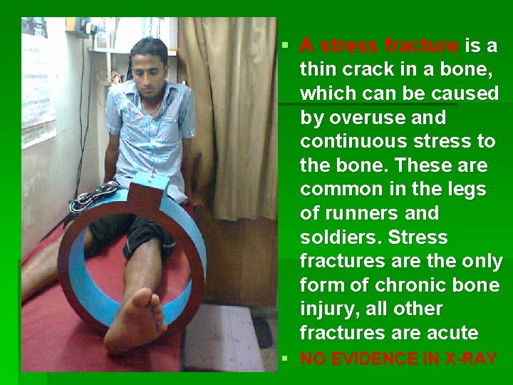 § A stress fracture is a thin crack in a bone, which can be