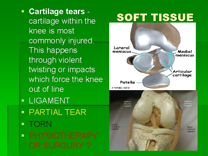 § Cartilage tears cartilage within the knee is most commonly injured. This happens through