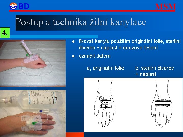 MSM Postup a technika žilní kanylace 4. fixovat kanylu použitím originální folie, sterilní čtverec