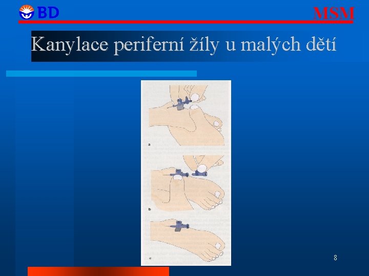 MSM Kanylace periferní žíly u malých dětí 8 