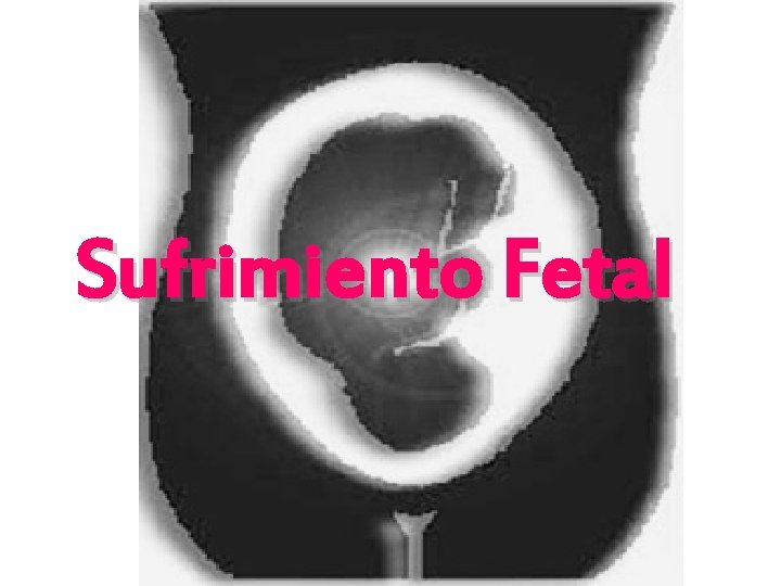 Sufrimiento Fetal 