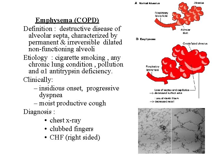 Emphysema (COPD) Definition : destructive disease of alveolar septa, characterized by permanent & irreversible