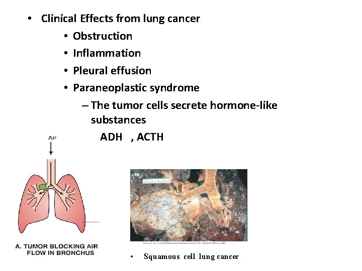  • Clinical Effects from lung cancer • Obstruction • Inflammation • Pleural effusion