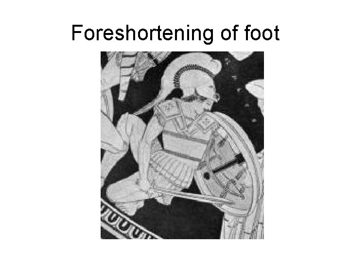 Foreshortening of foot 