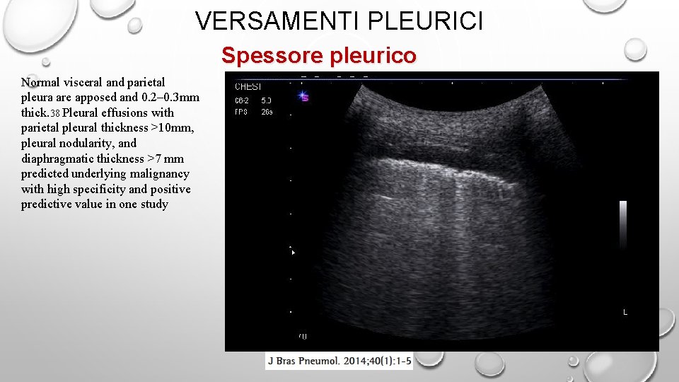 VERSAMENTI PLEURICI Spessore pleurico Normal visceral and parietal pleura are apposed and 0. 2–