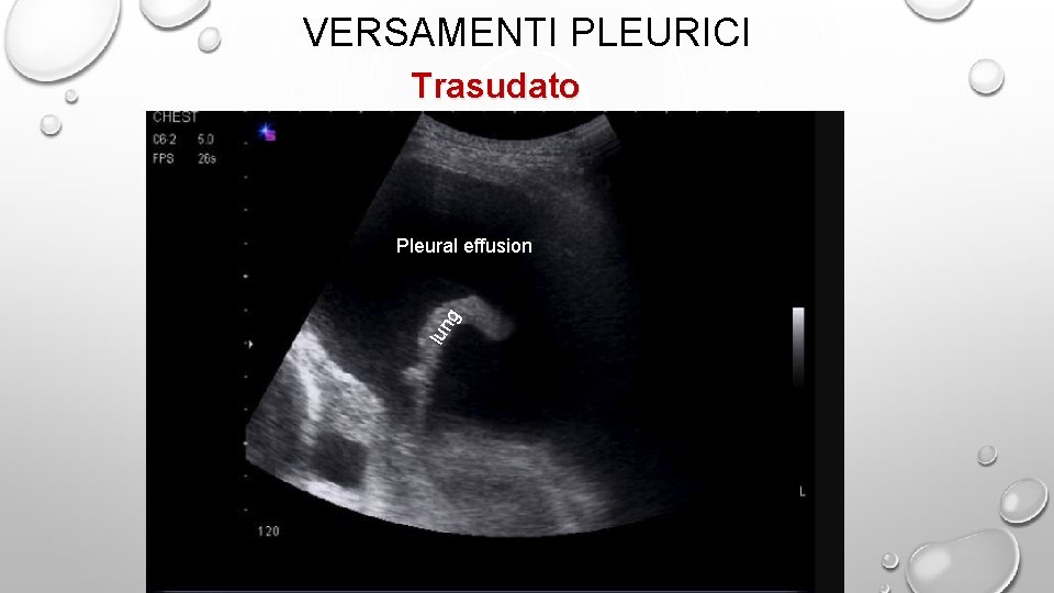 VERSAMENTI PLEURICI Trasudato lun g Pleural effusion 