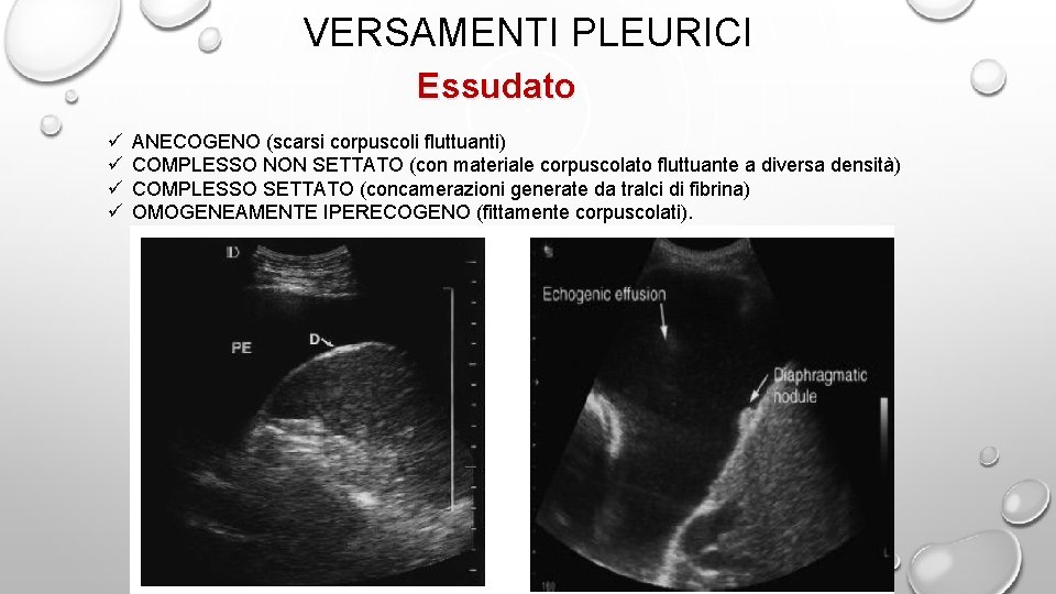 VERSAMENTI PLEURICI Essudato ü ü ANECOGENO (scarsi corpuscoli fluttuanti) COMPLESSO NON SETTATO (con materiale