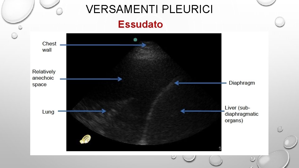 VERSAMENTI PLEURICI Essudato 