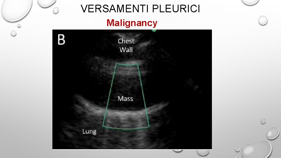 VERSAMENTI PLEURICI Malignancy 